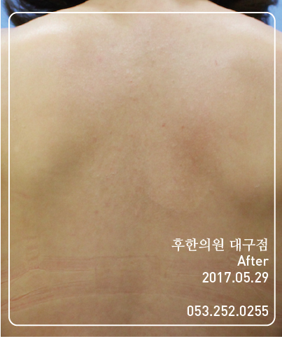 치료 후