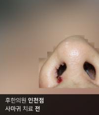 치료 전
