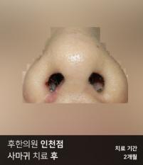 치료 후