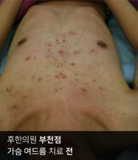 치료 전