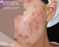 치료 전