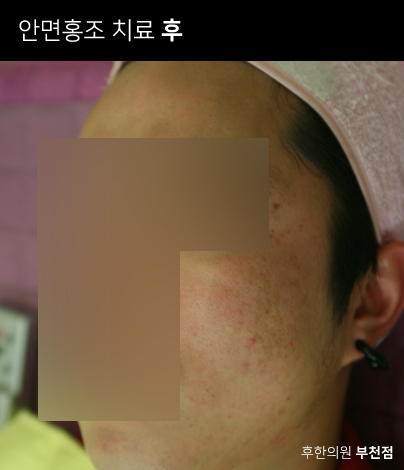 치료 후