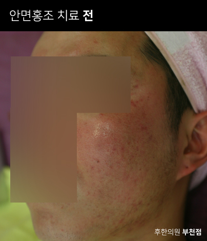 치료 전