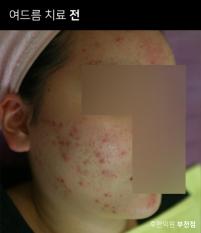 치료 전