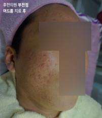 치료 후