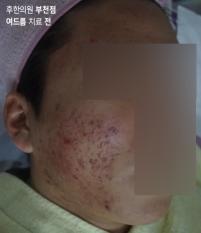 치료 전
