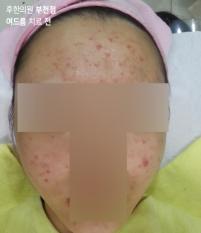치료 전