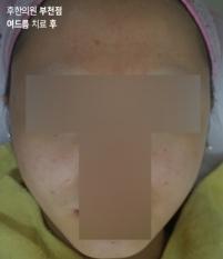 치료 후