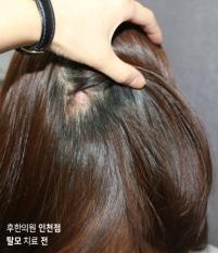 치료 전