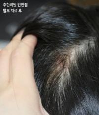치료 후
