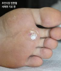 치료 전