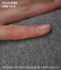 치료 후