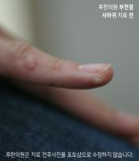 치료 전