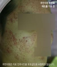 치료 전