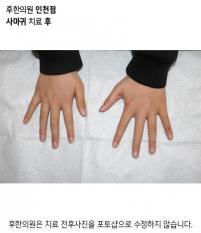 치료 후