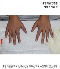 치료 전