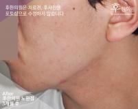 치료 후