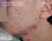 치료 전