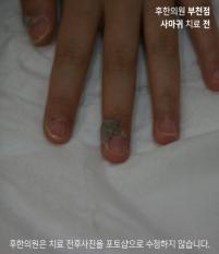 치료 전