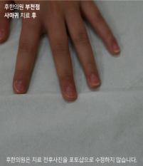 치료 후