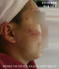 치료 전