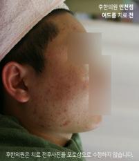 치료 전