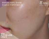 치료 후