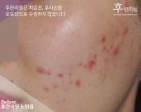 치료 전