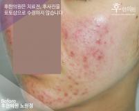 치료 전