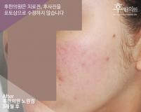 치료 후