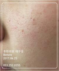 치료 전