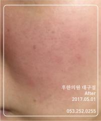 치료 후