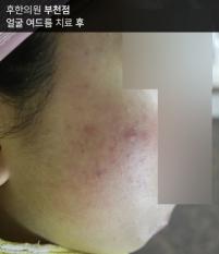 치료 후