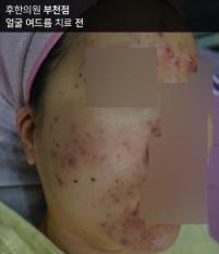 치료 전