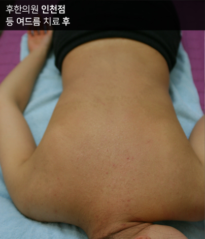 치료 후