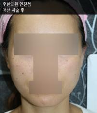 치료 후