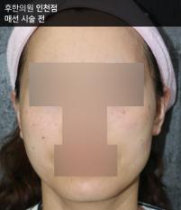 치료 전
