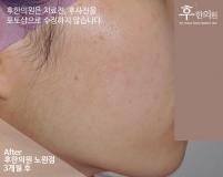 치료 후