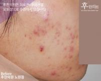 치료 전