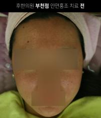 치료 전