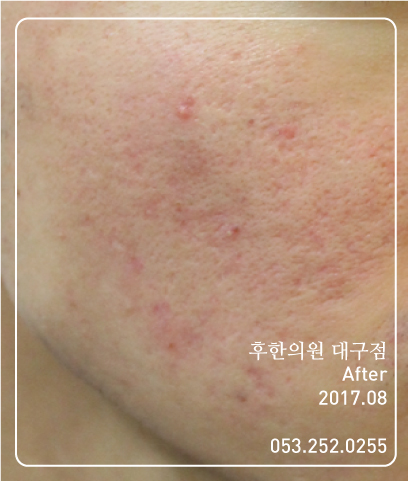 치료 후
