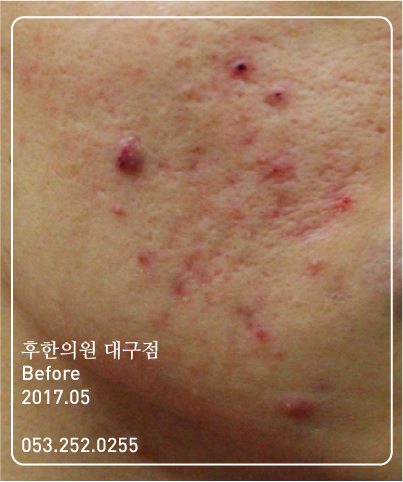치료 전