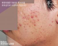 치료 전