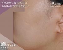 치료 후