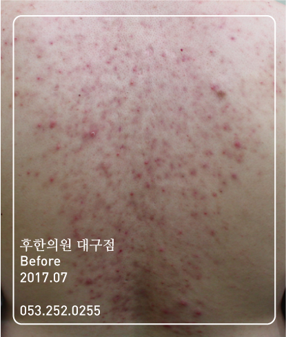치료 전