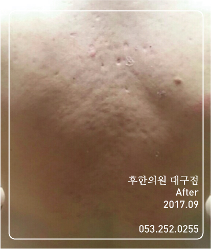 치료 후