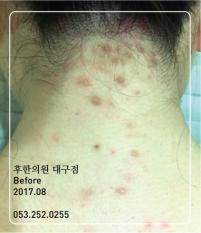 치료 전