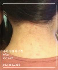 치료 후
