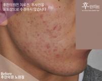 치료 전