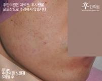 치료 후